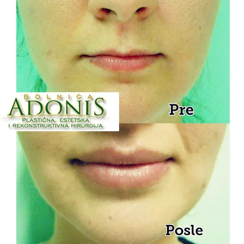 Korekcija i uvećanje usana ADONIS - Bolnica za estetsku hirurgiju Adonis - 2