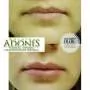 Korekcija i uvećanje usana ADONIS - Bolnica za estetsku hirurgiju Adonis - 1
