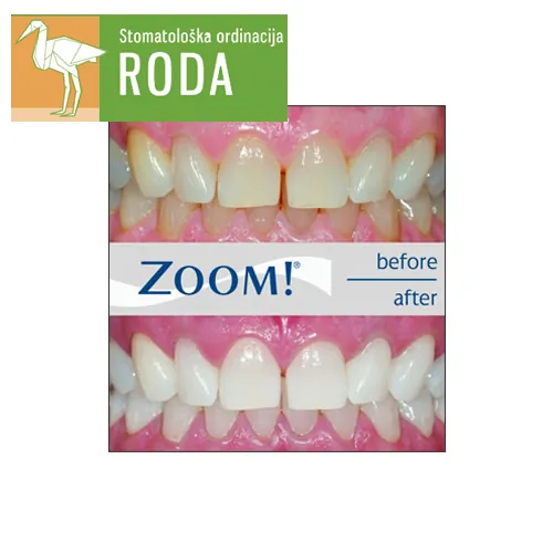 Izbeljivanje zuba ORDINACIJA RODA - Stomatološka ordinacija Roda - 2