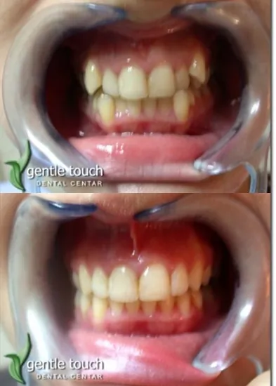Fiksna proteza metalne bravice GENTLE TOUCH DENTAL CENTAR - Stomatološka ordinacija Gentle touch Dental centar - 4