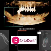 3D POLJE 85X85 CM - OrtoDent 3D Digital snimanje zuba - 3