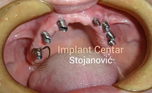 Ugradnja implantata sa suprastrukturom (nadogradnjom) DENTAL CENTAR STOJANOVIĆ - Implant Centar Stojanović - 3