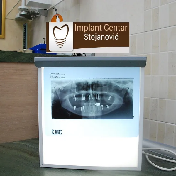 Ugradnja implantata sa suprastrukturom (nadogradnjom) DENTAL CENTAR STOJANOVIĆ - Implant Centar Stojanović - 1
