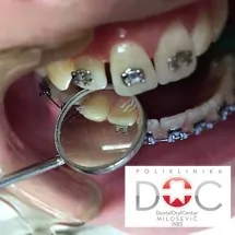 Fiksne proteze DENTAL ORAL CENTAR MILOŠEVIĆ - Stomatološka ordinacija Dental Oral Centar Milošević - 1