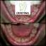 Uklanjanje zubnog kamenca i poliranje DENTINA - Stomatološka ordinacija Dentina - 1