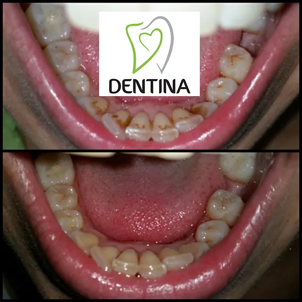 Uklanjanje zubnog kamenca i poliranje DENTINA - Stomatološka ordinacija Dentina - 1