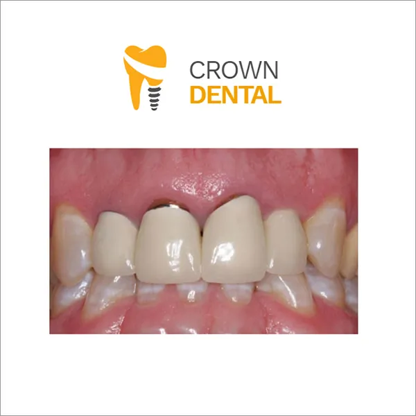 Bezmetalna keramička krunica CROWN DENTAL - Stomatološka ordinacija Crown Dental - 2