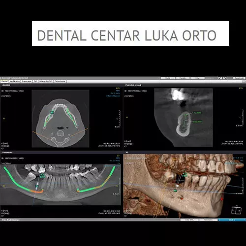 3D SNIMAK XL polje 8×15 - Dental centar Luka Orto - 2