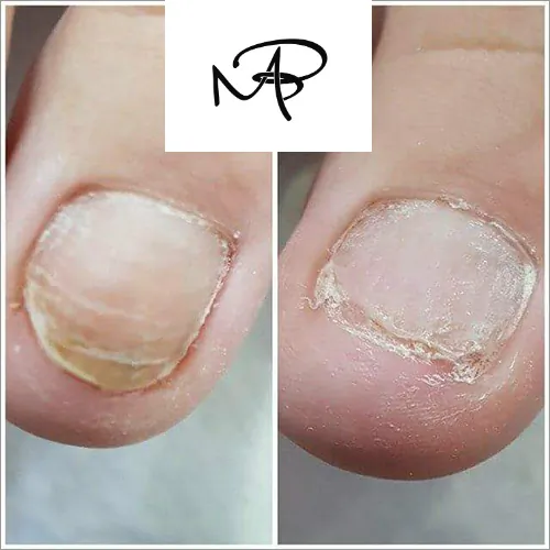 Lasersko lečenje gljivice na noktima nogu ESTETSKI CENTAR DR MARIJA BOŠKOVIĆ - Medical Beauty - Estetski centar dr Marija Bošković - 2