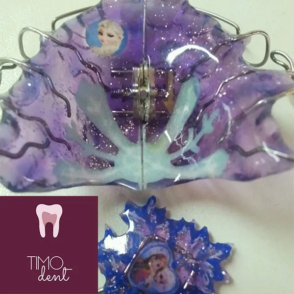 Pokretni ortodontski aparati TIMO DENT - Timo Dent Stomatološka ordinacija - 2