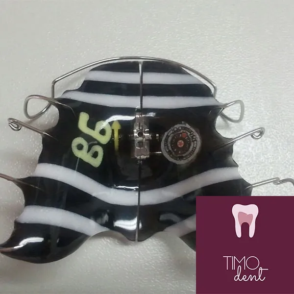 Pokretni ortodontski aparati TIMO DENT - Timo Dent Stomatološka ordinacija - 1