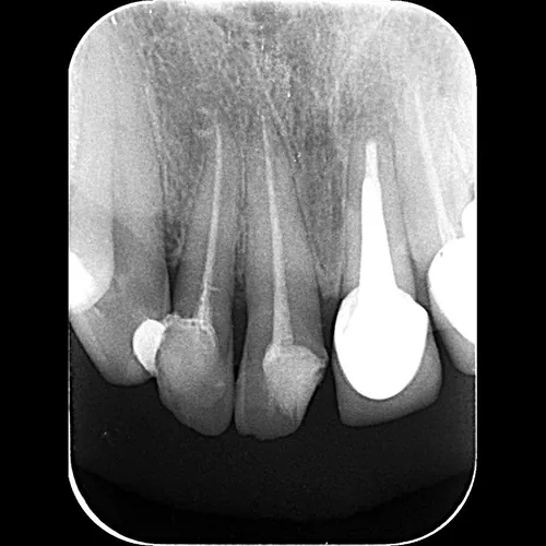 MALI SNIMAK  RETROALVEOLARNI RETROKORONARNI - Centar za snimanje zuba Diamond 3D - 3