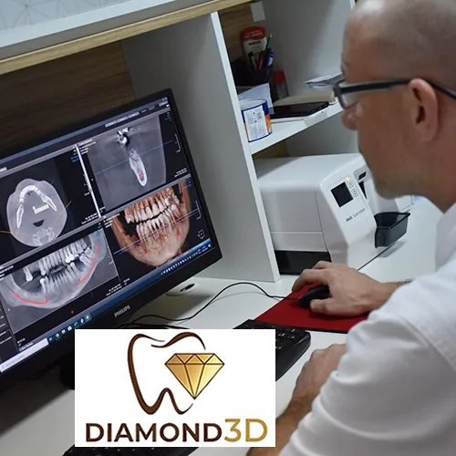 3D CBCT  Najvece radno polje XL 13x15 - Centar za snimanje zuba Diamond 3D - 3