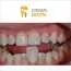 Viniri CROWN DENTAL - Stomatološka ordinacija Crown Dental - 2