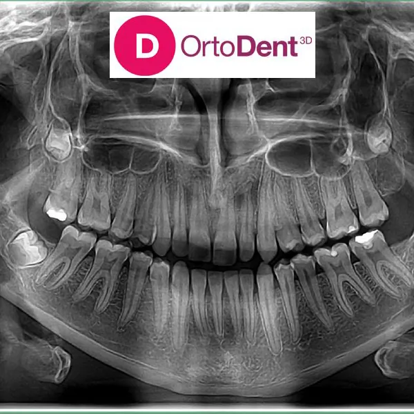 Dentalni radiogrami ORTO DENT DIGITAL 3D - ORTOPAN CENTAR - Orto Dent Digital 3D - Ortopan centar - 1