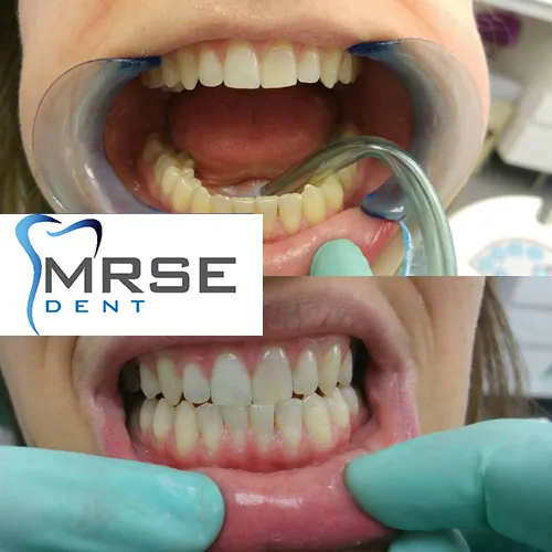 Beljenje zuba MRSE DENT - Stomatološka ordinacija Mrse Dent - 3