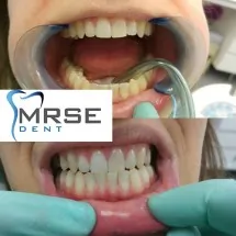 Beljenje zuba MRSE DENT - Stomatološka ordinacija Mrse Dent - 2