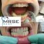 Beljenje zuba MRSE DENT - Stomatološka ordinacija Mrse Dent - 2