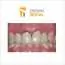 Metalokeramička krunica CROWN DENTAL - Stomatološka ordinacija Crown Dental - 2
