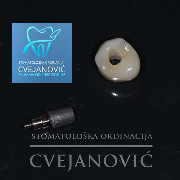 Ugradnja zubnih implantata Impant Direct ORDINACIJA CVEJANOVIĆ - Stomatološka ordinacija Cvejanović - 1