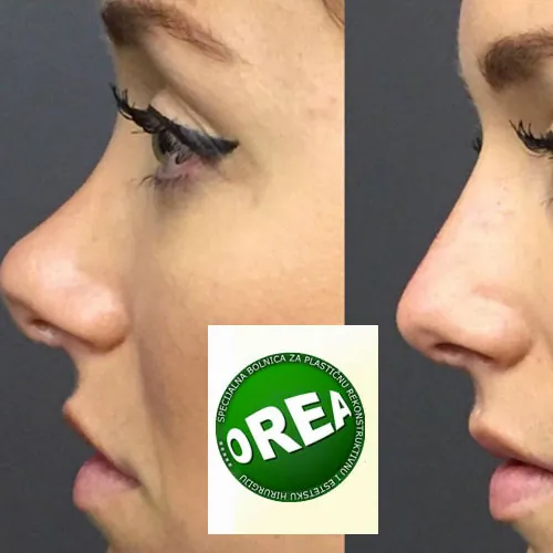 Operacija nosa OREA - Specijalistička bolnica za estetsku hirgiju Orea - 3