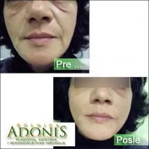 Korekcija bora ADONIS - Bolnica za estetsku hirurgiju Adonis - 1