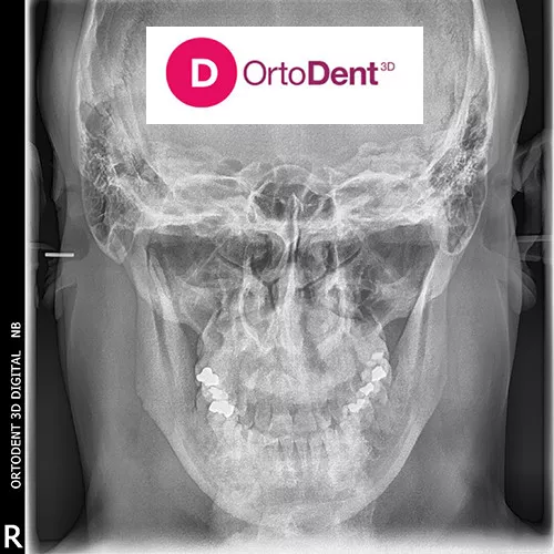 PA CEFALOGRAM - OrtoDent 3D Digital snimanje zuba - 1