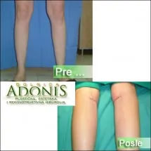 Dermoplastika podkolenica ADONIS - Bolnica za estetsku hirurgiju Adonis - 1