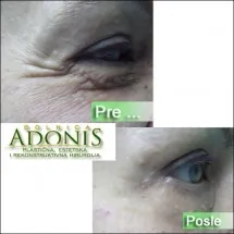 Korekcija očnih kapaka ADONIS - Bolnica za estetsku hirurgiju Adonis - 1