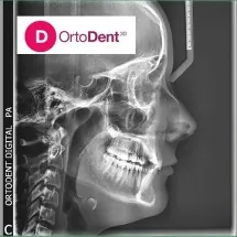 Profilni cefalogram ORTODENT 3D DIGITAL SNIMANJE ZUBA - OrtoDent 3D Digital snimanje zuba - 1