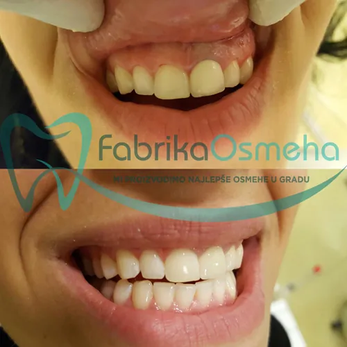 Beljenje zuba ORDINACIJA FABRIKA OSMEHA - Stomatološka ordinacija Fabrika Osmeha - 5