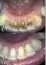 Uklanjanje zubnog kamenca GENTLE TOUCH DENTAL CENTAR - Stomatološka ordinacija Gentle touch Dental centar - 3