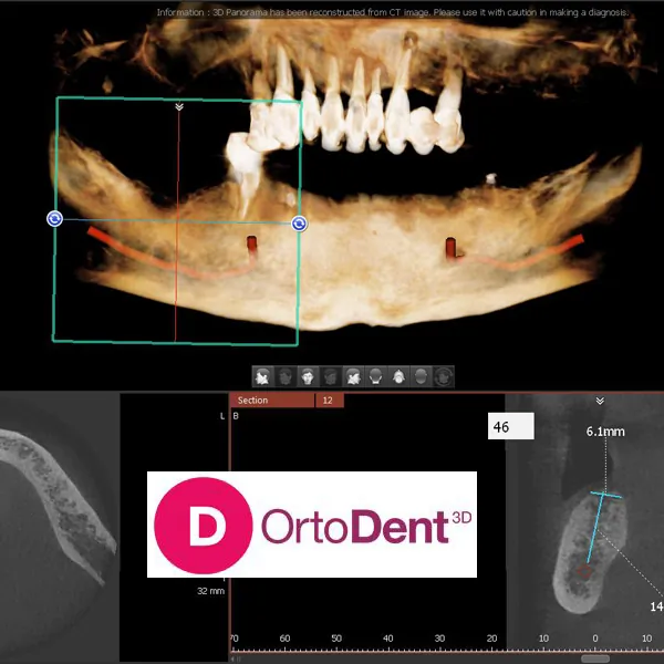 3D POLJE 85X5 ORTODENT 3D DIGITAL SNIMANJE ZUBA - OrtoDent 3D Digital snimanje zuba - 3
