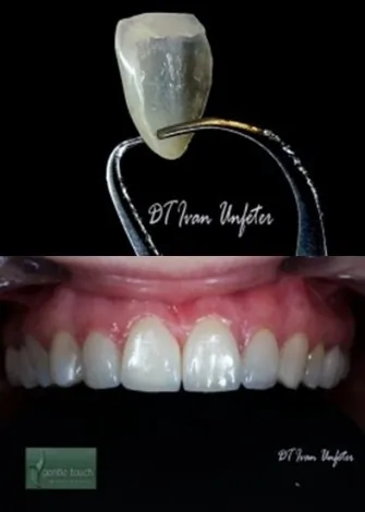 Stomatološka ordinacija Gentle touch Dental centar - ESTETSKA STOMATOLOGIJA  GENTLE TOUCH DENTAL CENTAR - 1
