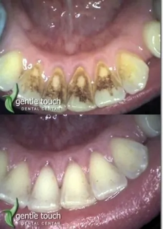 Stomatološka ordinacija Gentle touch Dental centar - PARODONTOLOGIJA GENTLE TOUCH DENTAL CENTAR - 1