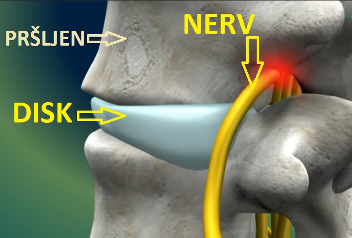 Blog ilustracija: Diskus hernija operacija ili fizikalna terapija