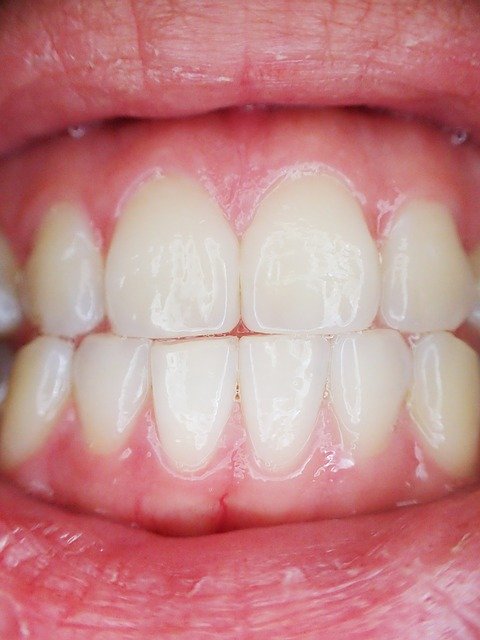 Blog ilustracija: U stomatološkim ordinacijama otkrivaju šta je bruksizam i kako se leči