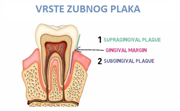 Blog ilustracija: Šta je to zubni plak i da li je opasan