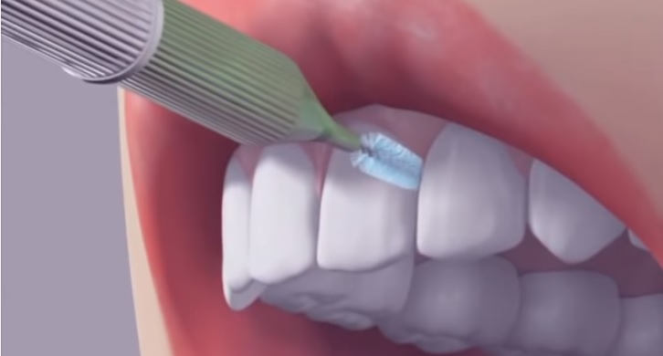 Blog ilustracija: U Koristite interdentalne (međuzubne) četkice za zube – preporučuju stomatološke ordinacije