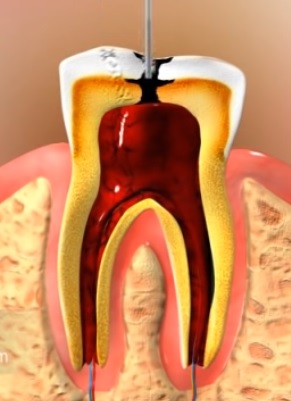 Blog ilustracija: Šta podrazumeva lečenje kanala korena zuba u stomatološkoj ordinaciji